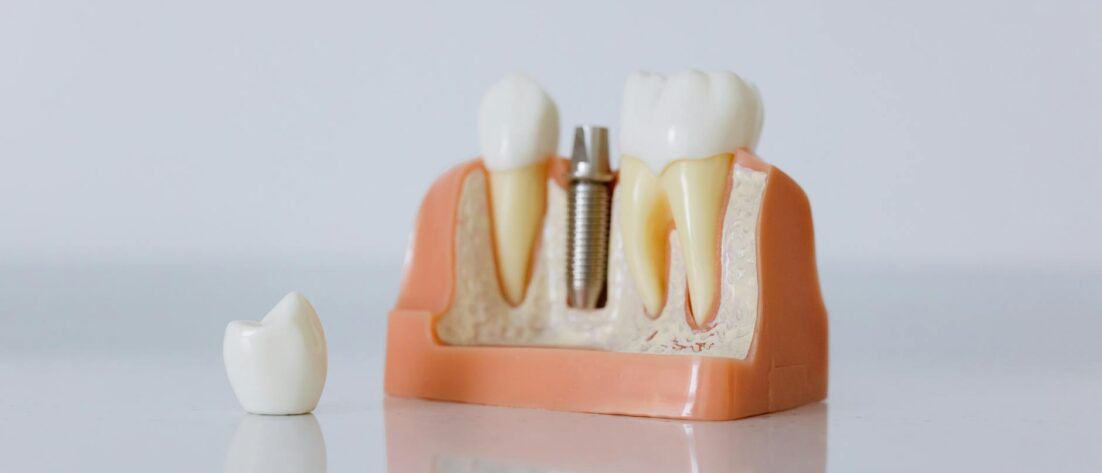 close up shot of dental implant model