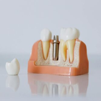 close up shot of dental implant model